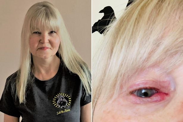 Huge cyst pops out of woman's eye after year of agony as she feared ...