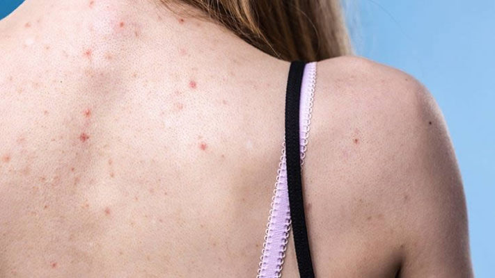 Why More People Are Getting Body Acne Than Ever