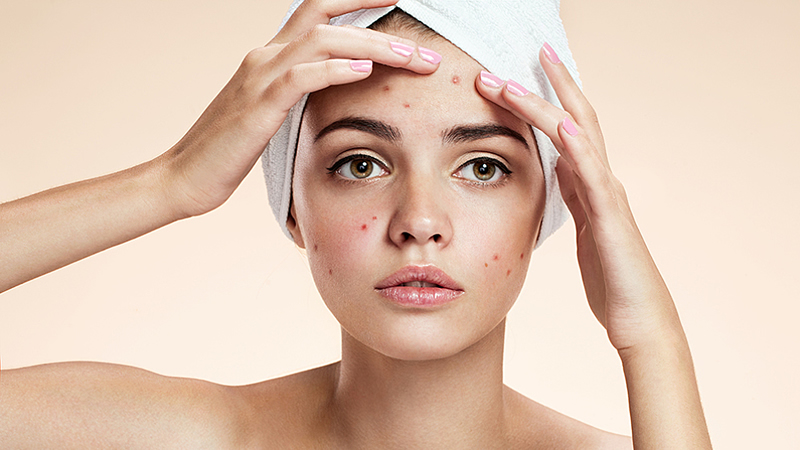 9 Things to Know If You Have Acne-Prone Skin