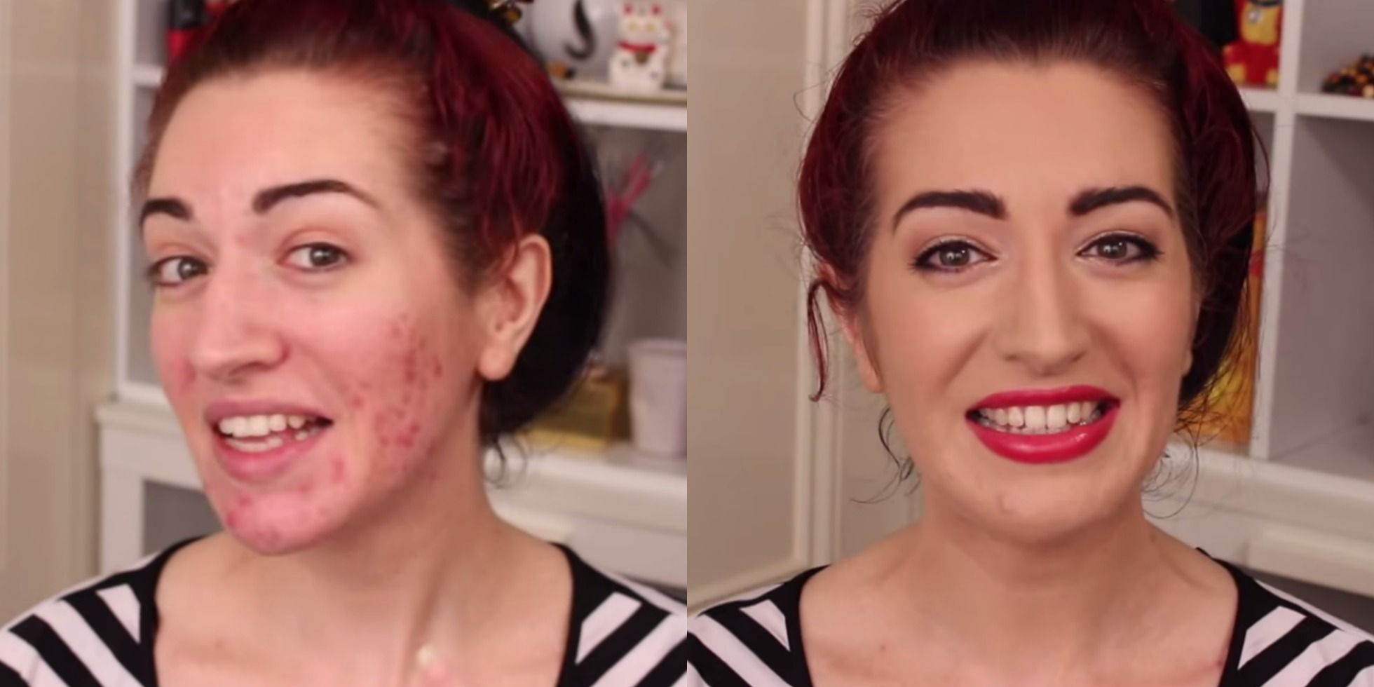 5 Great Ways to Hide Acne Scars