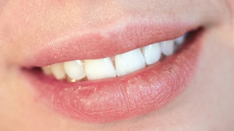 How Should You Treat Sunburnt Lips