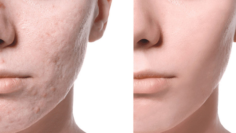 Say Goodbye to Acne Scars: The Latest Breakthroughs and Techniques