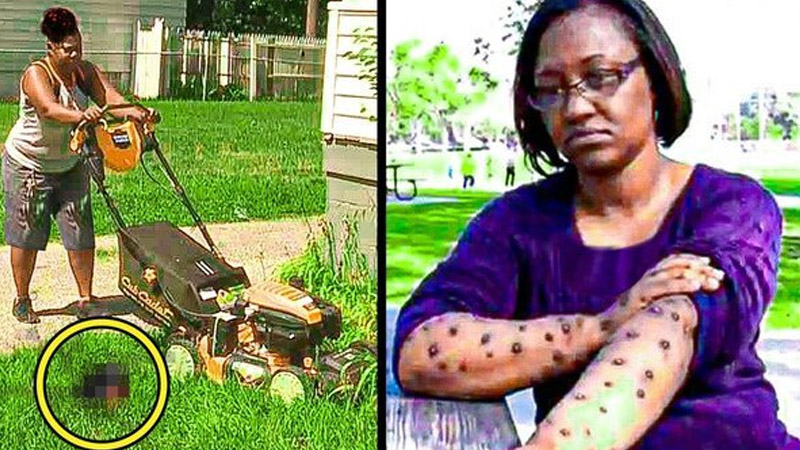 Woman Was Bitten While Mowing Her Yard