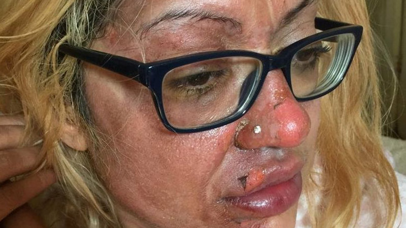 Woman left with horrific facial burns