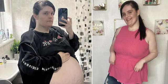 Strangers thought I was pregnant due to cyst filled
