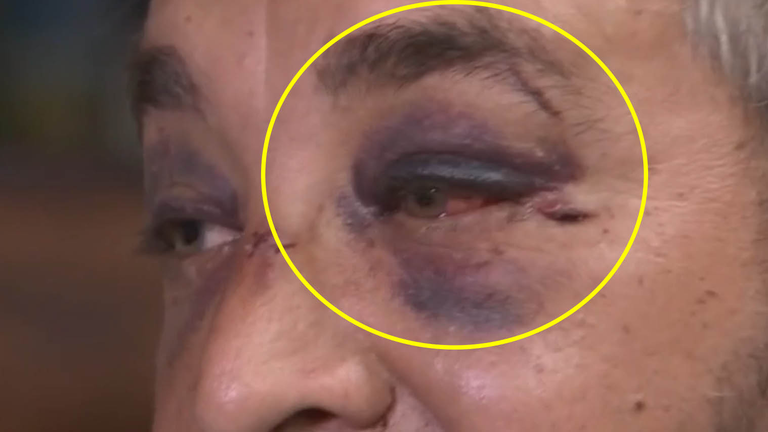 Vince Villanueva bruised face