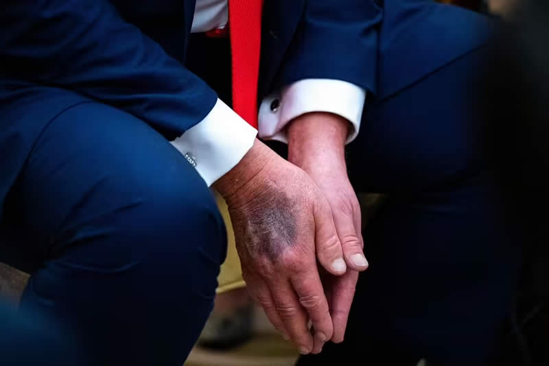 Trump hand bruise