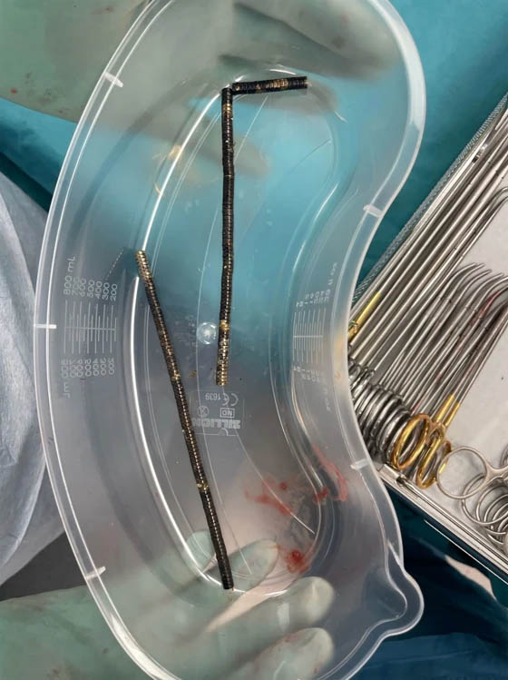 Approximately 80–100 high-powered magnets retrieved following surgery