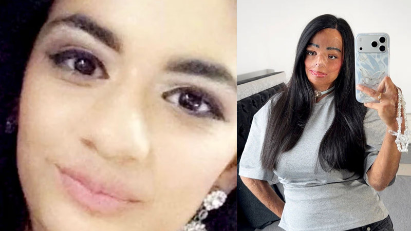 Girl burnt across half her body