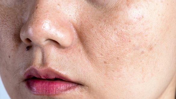 Why Your Pores Look Bigger and How to Minimize Them (Getty)